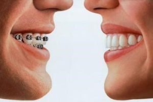 Ορθοδοντικά προβλήματα χαμόγελο όμορφα δόντια σιδεράκια